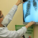 fiocruz_amazonia-150x150 Baixo financiamento mundial ameaça combate à tuberculose