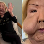 FotoJet-2025-11-25T191302.296-150x150 Médico surpreende ao mostrar óleo mineral enrijecido retirado do rosto de Juju do Pix: "Foi muito difícil"; veja foto